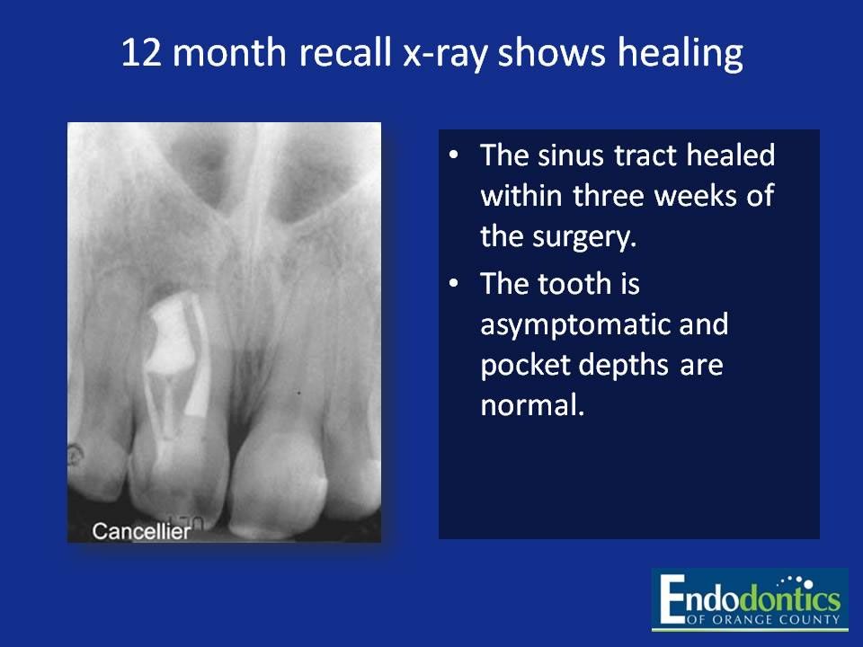 Successful Endodontic Cases Irvine, CA Endodontics of Orange County